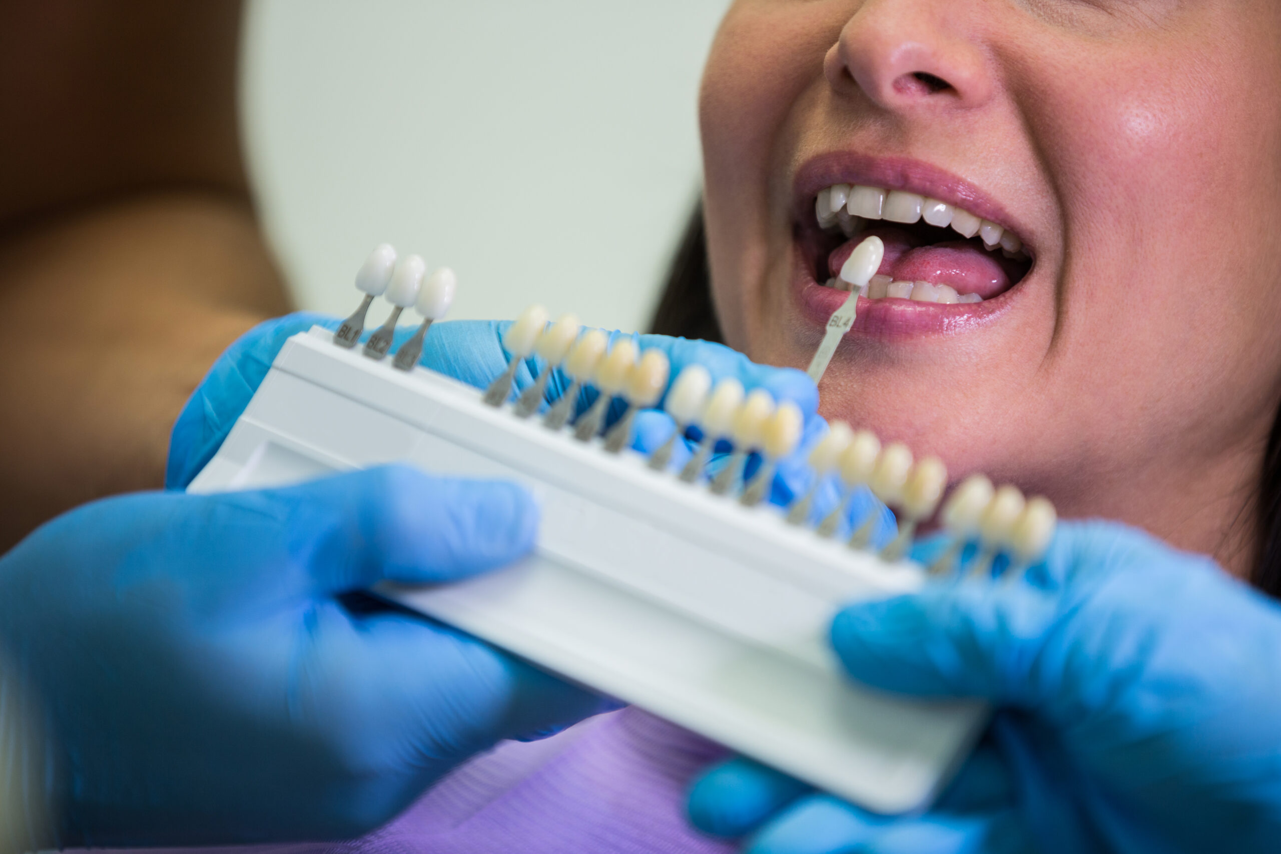 veneers in river oaks